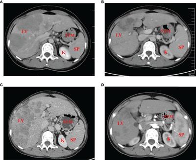 Case report: Significant response to PD-L1 inhibitor after resistance to PD-1 inhibitor in an advanced alpha-fetoprotein-positive gastric cancer